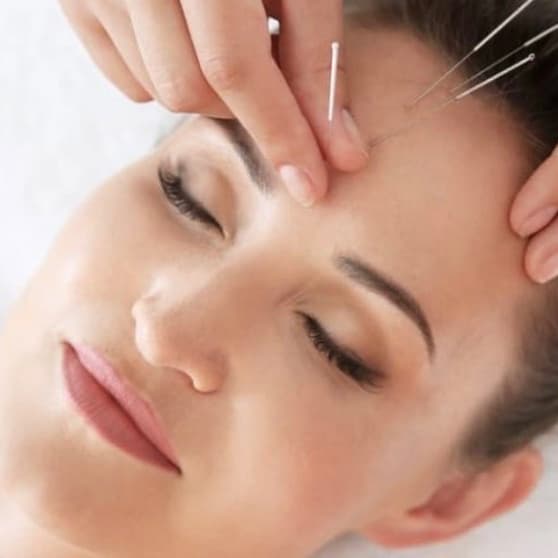 Acupuncture Four Pack at Vital Lounge (Downtown Phoenix Wellness Hub) in Phoenix, AZ